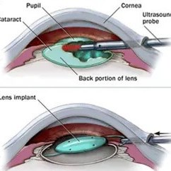 Cataracts